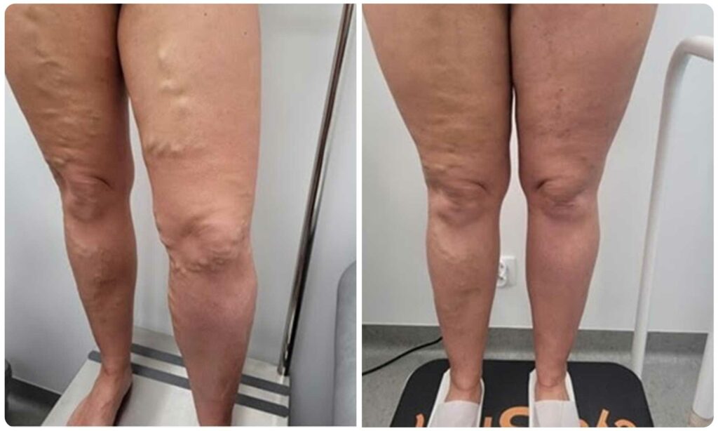 Metamorfoza EVLA i miniflebektomia