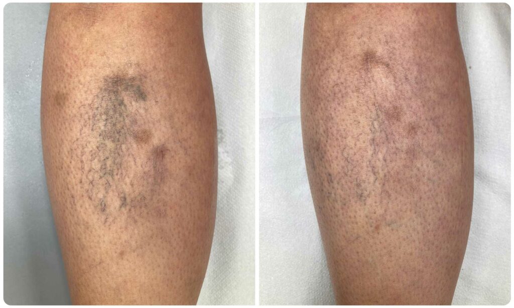 Metamorfoza skleroterapia