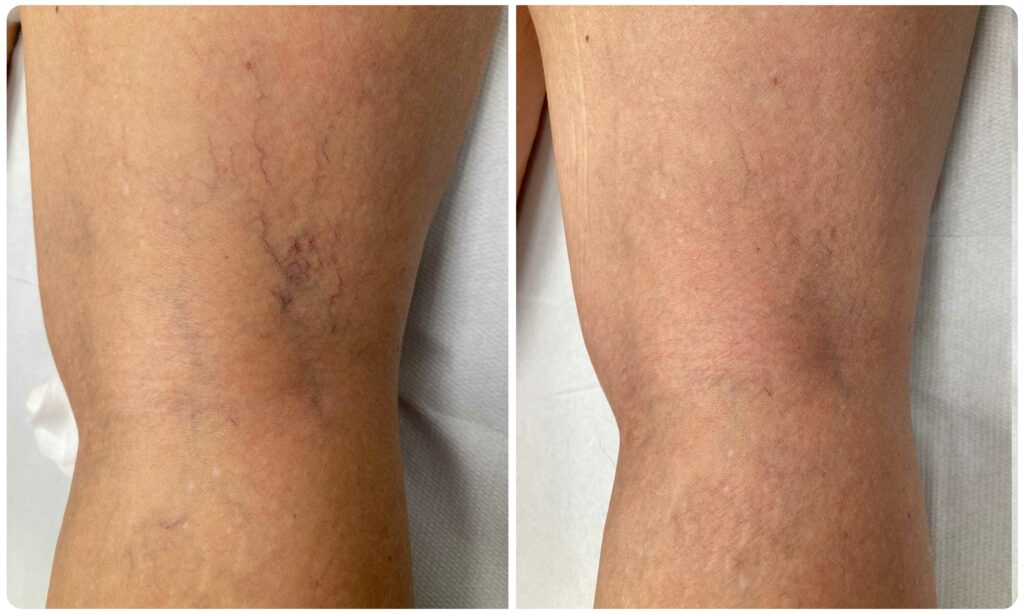 Metamorfoza skleroterapia