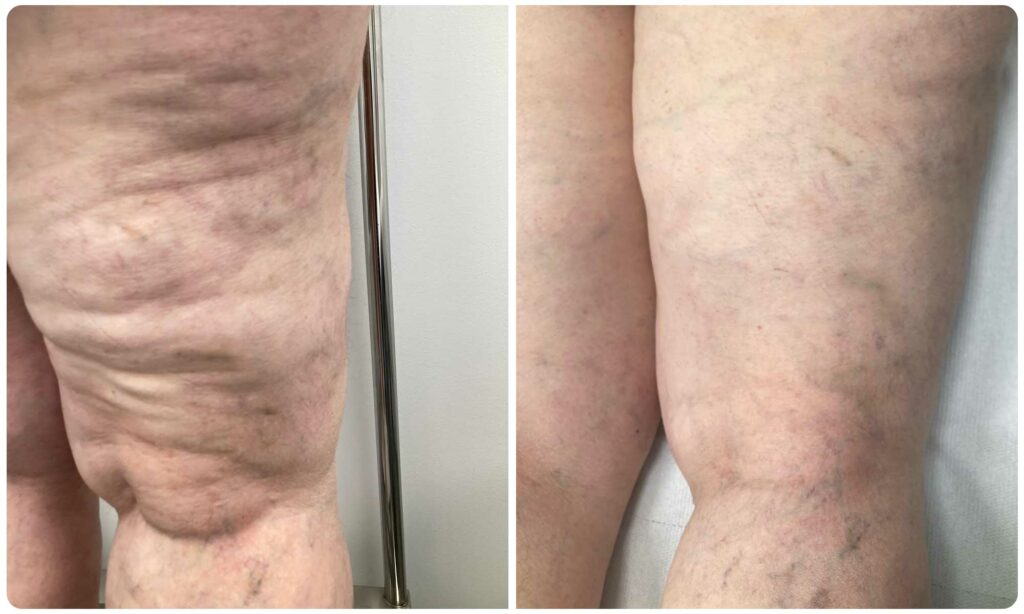 Metamorfoza skleroterapia