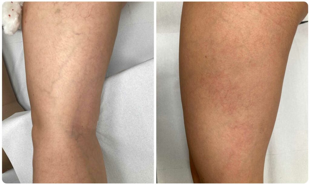 Metamorfoza skleroterapia