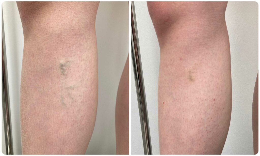 Metamorfoza skleroterapia