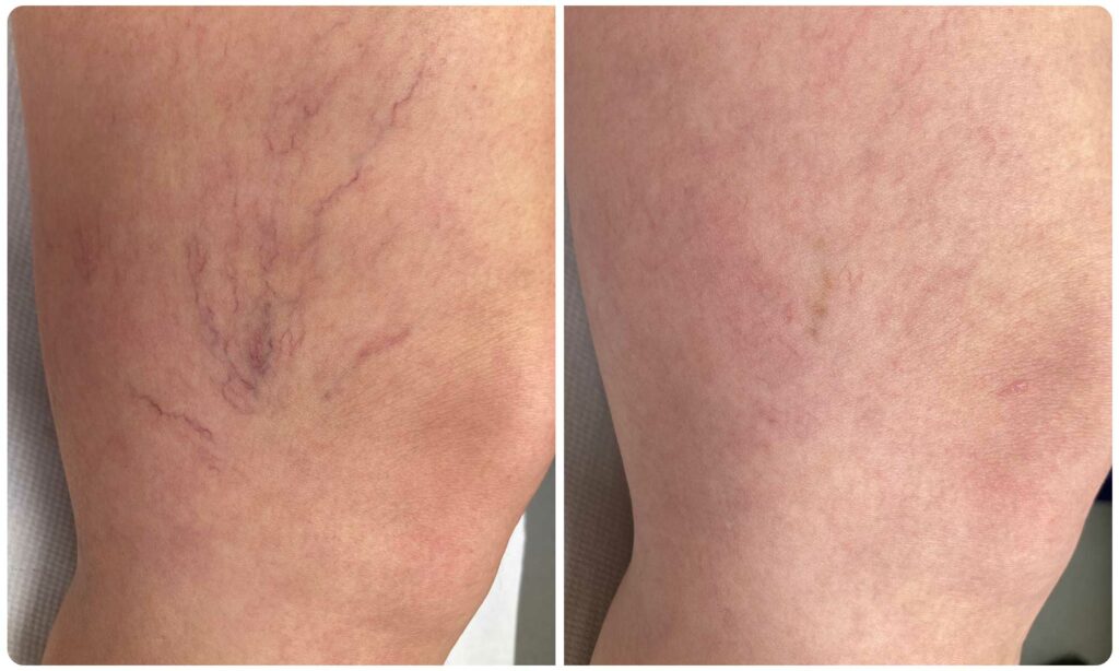 Metamorfoza skleroterapia