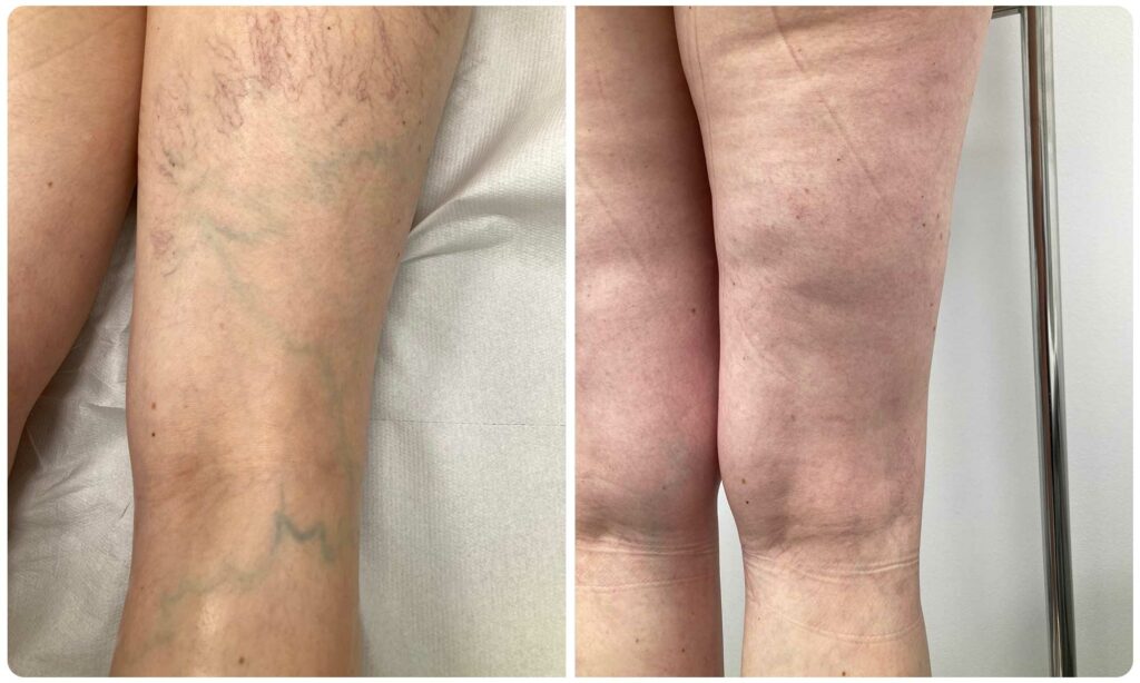 Metamorfoza skleroterapia