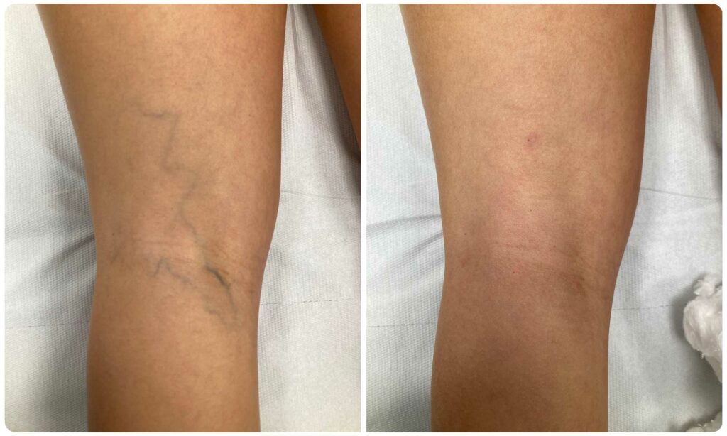 Metamorfoza skleroterapia